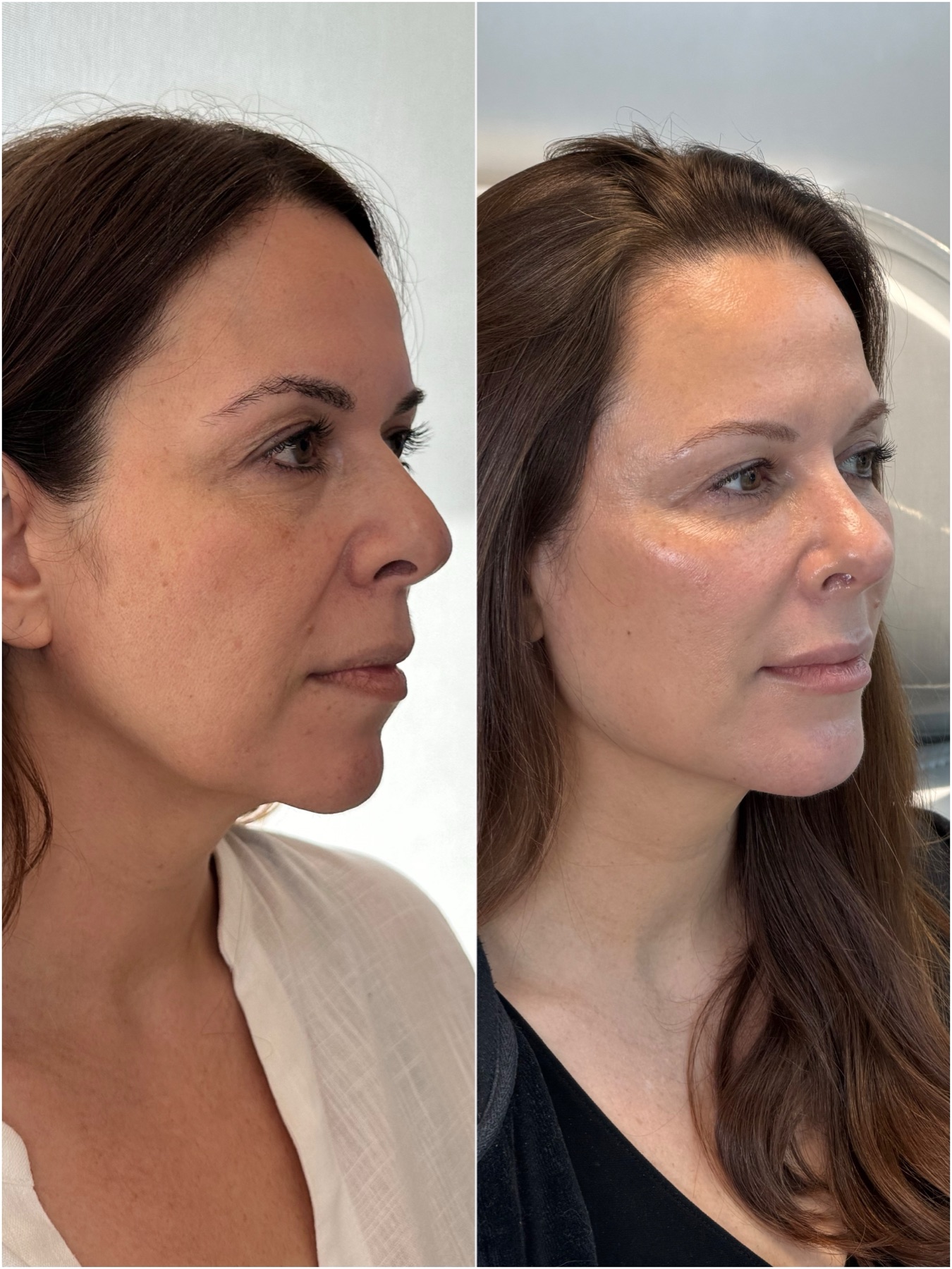 Harmonização facial — resultado de harmonização facial na RUV