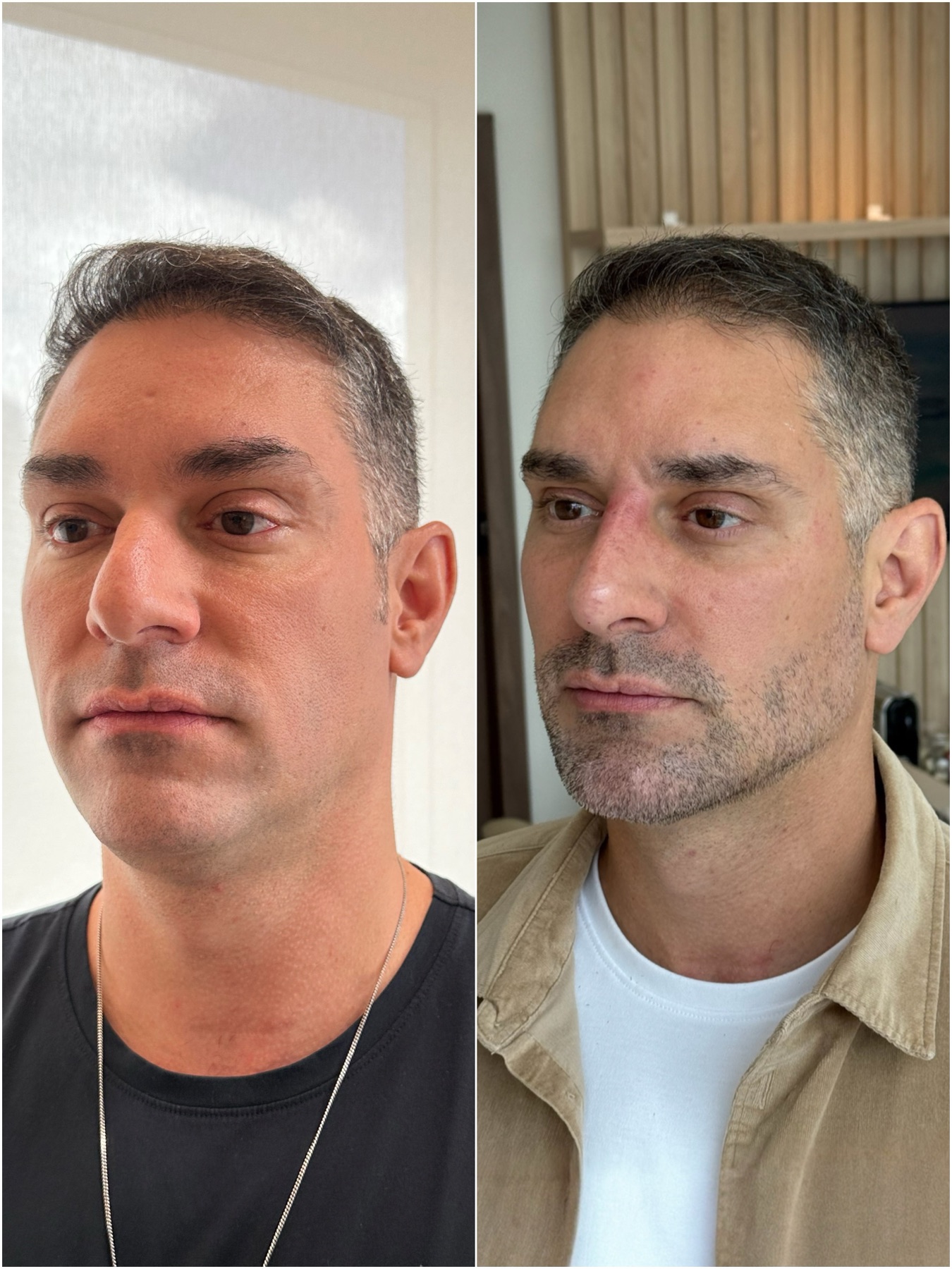 Harmonização facial — resultado de harmonização facial na RUV