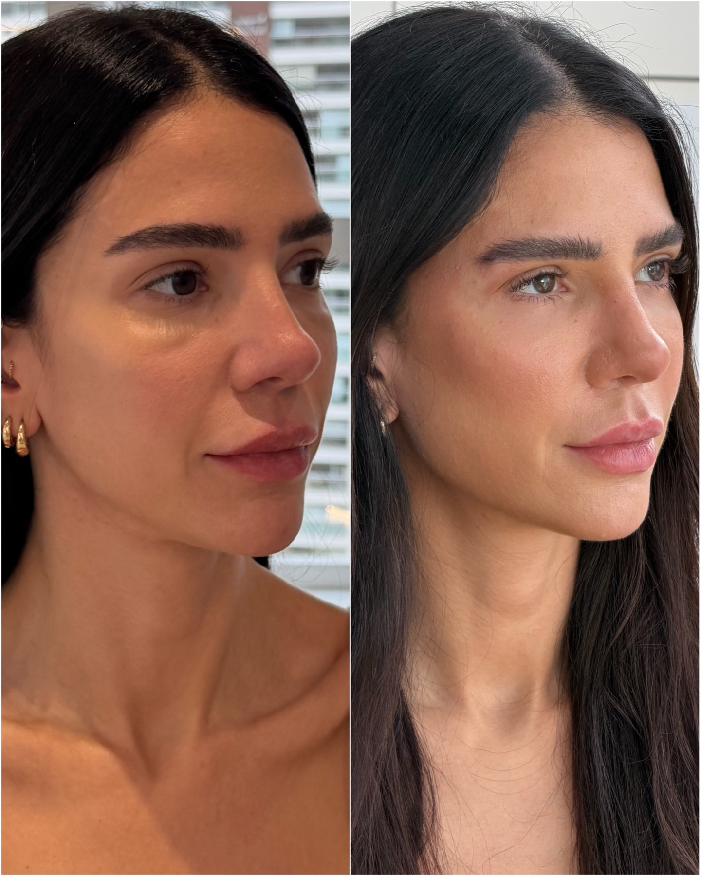 Harmonização facial — resultado de harmonização facial na RUV