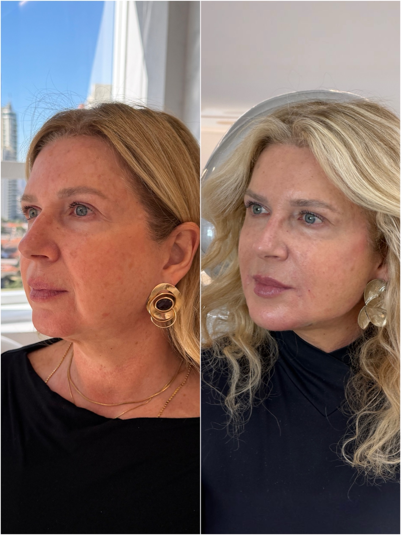 Harmonização facial — resultado de harmonização facial na RUV