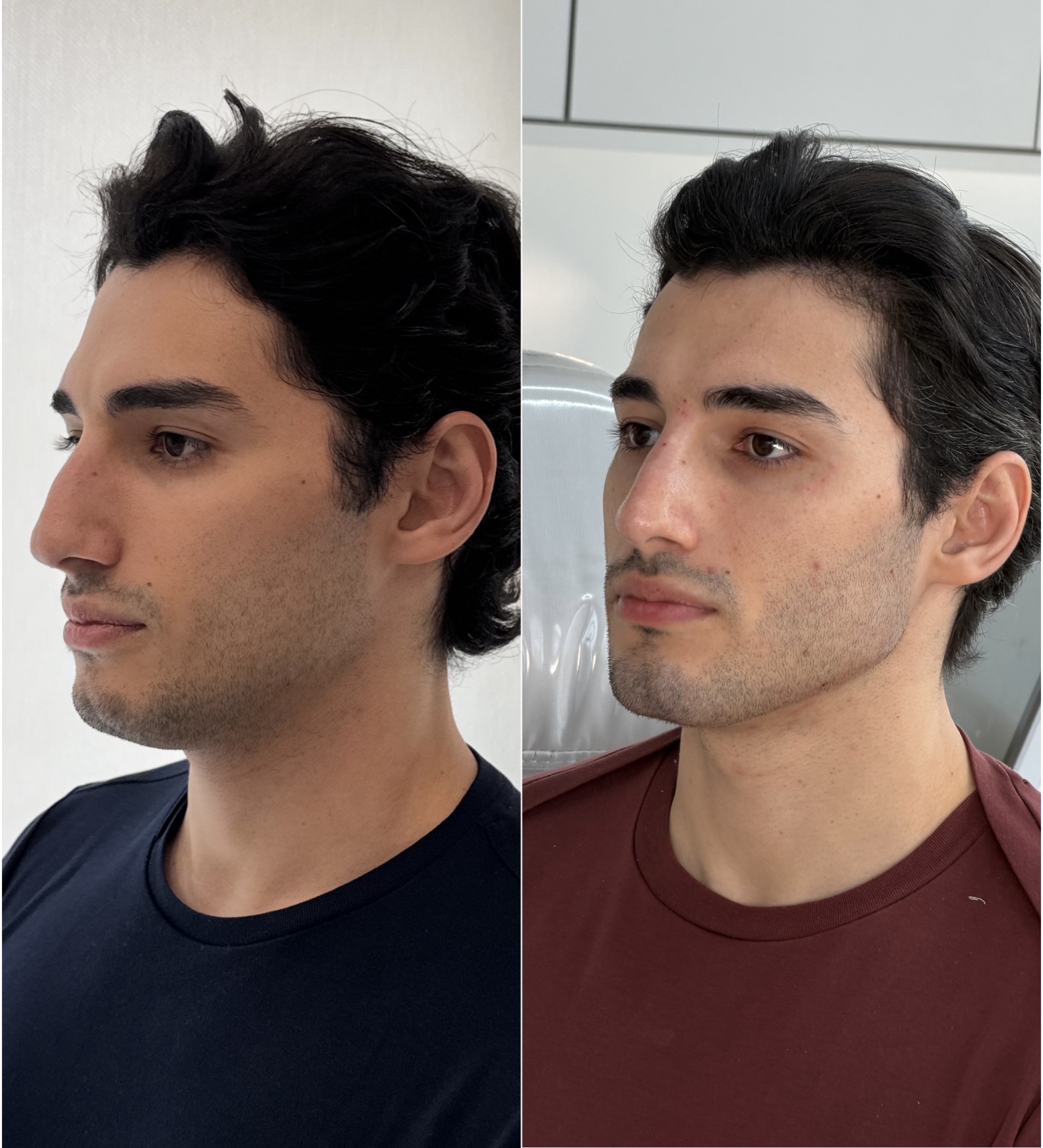 Harmonização facial — resultado de harmonização facial na RUV