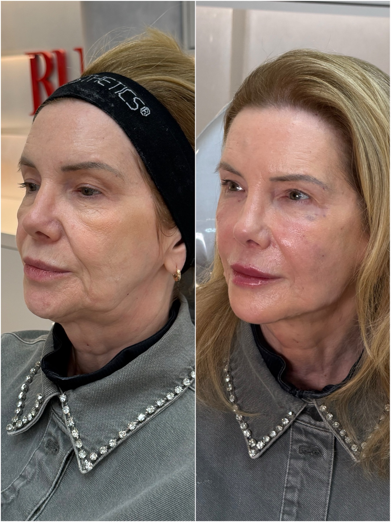 Harmonização facial — resultado de harmonização facial na RUV