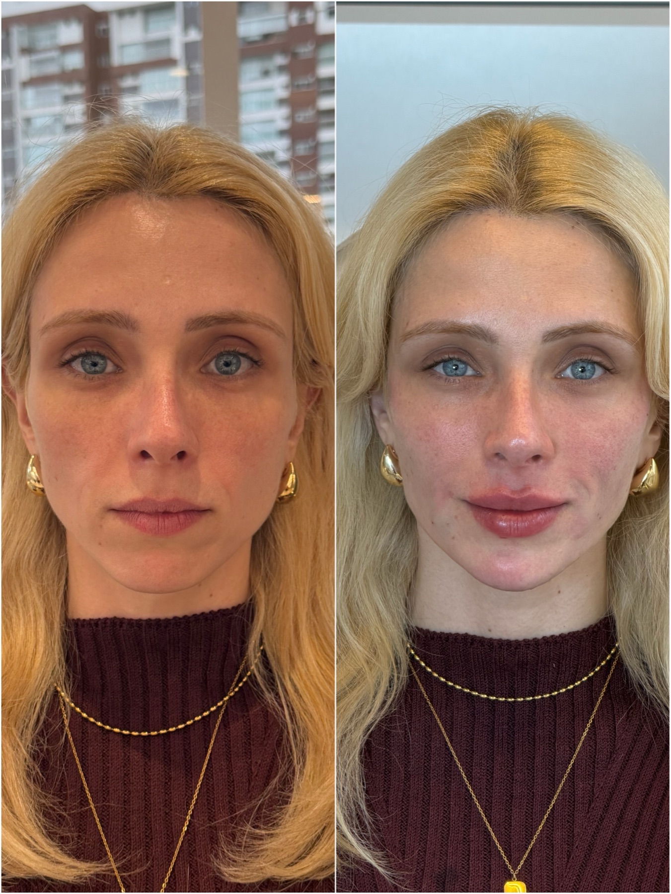 Harmonização facial — resultado de harmonização facial na RUV