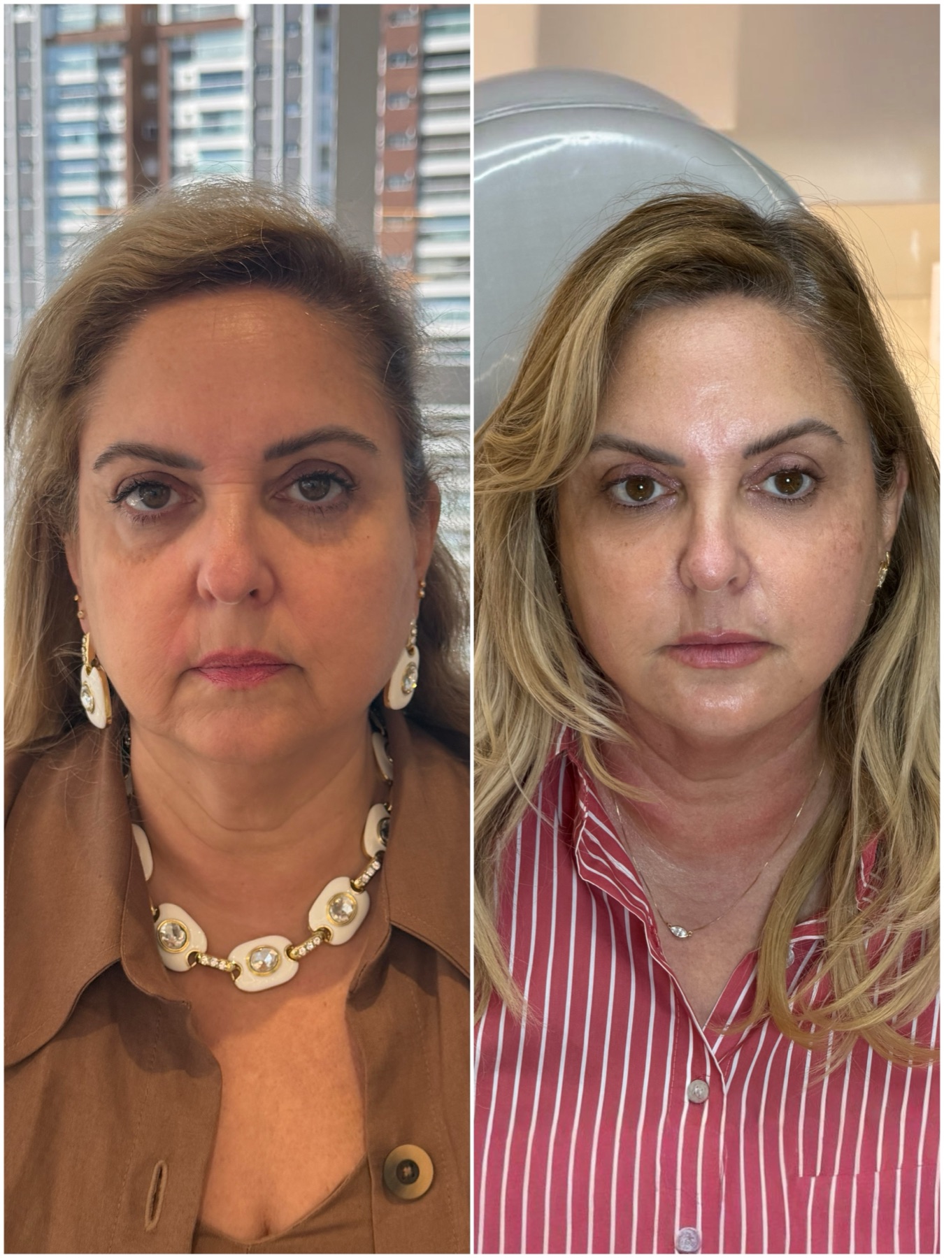 Harmonização facial — resultado de harmonização facial na RUV