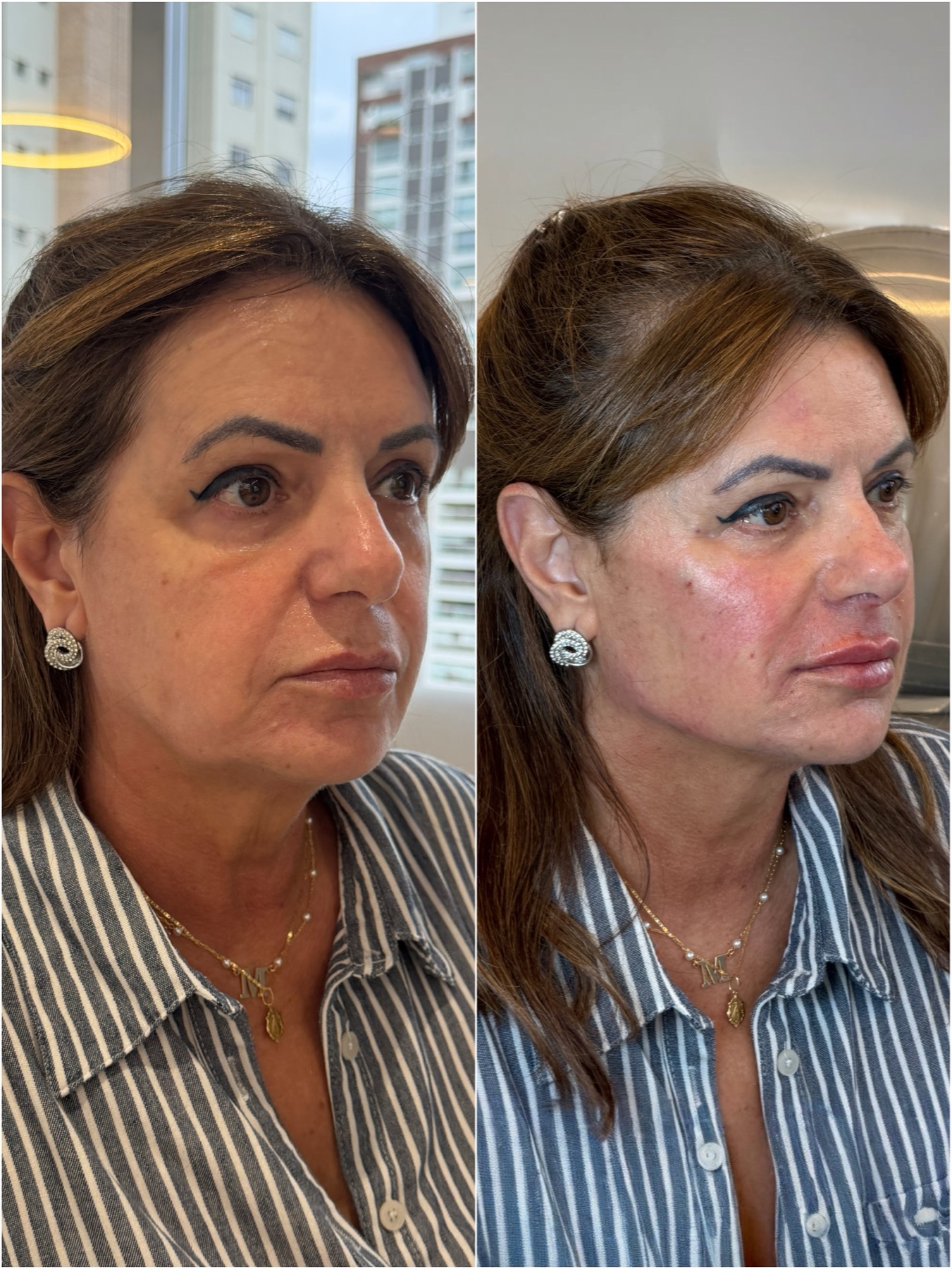 Harmonização facial — resultado de harmonização facial na RUV