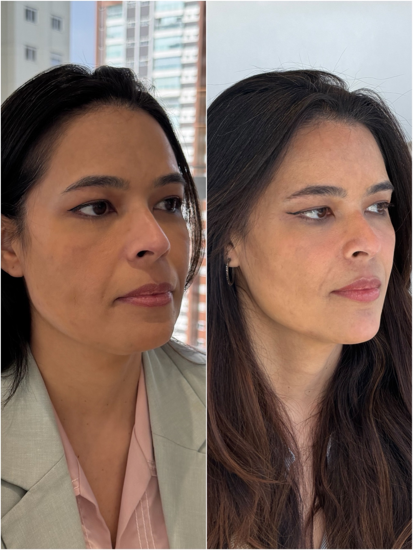 Harmonização facial — resultado de harmonização facial na RUV