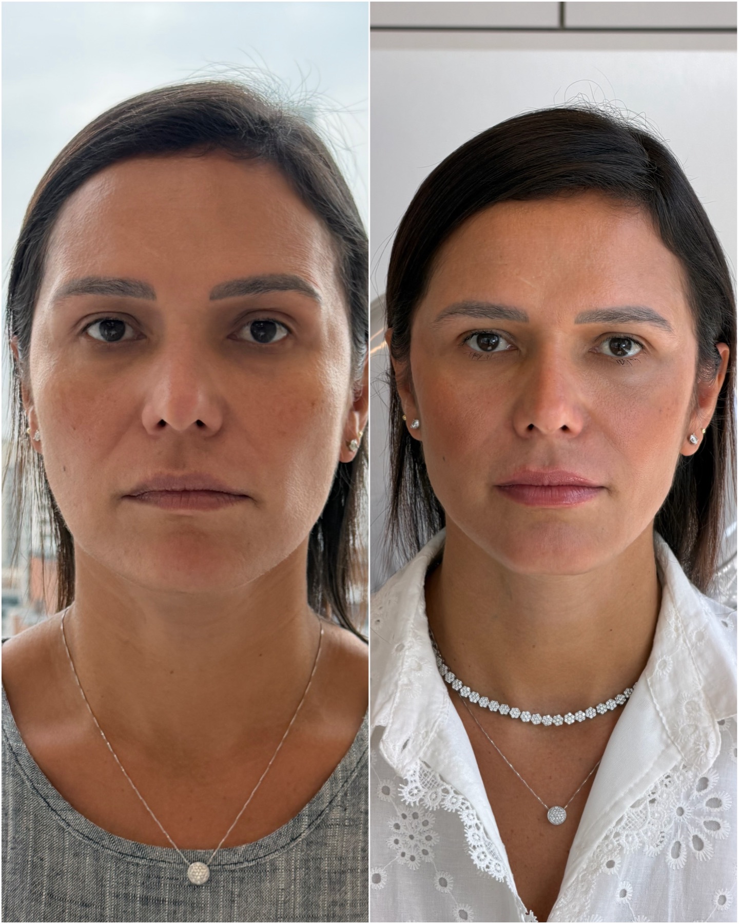 Harmonização facial — resultado de harmonização facial na RUV