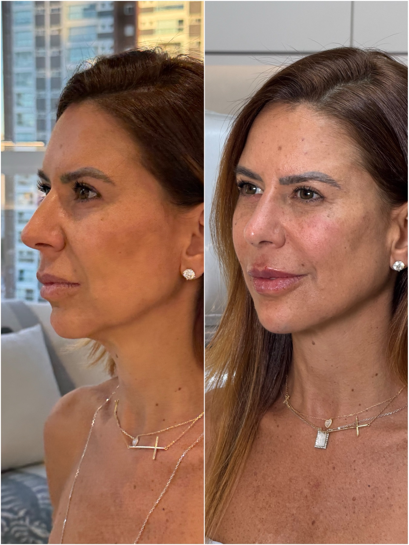 Harmonização facial — resultado de harmonização facial na RUV