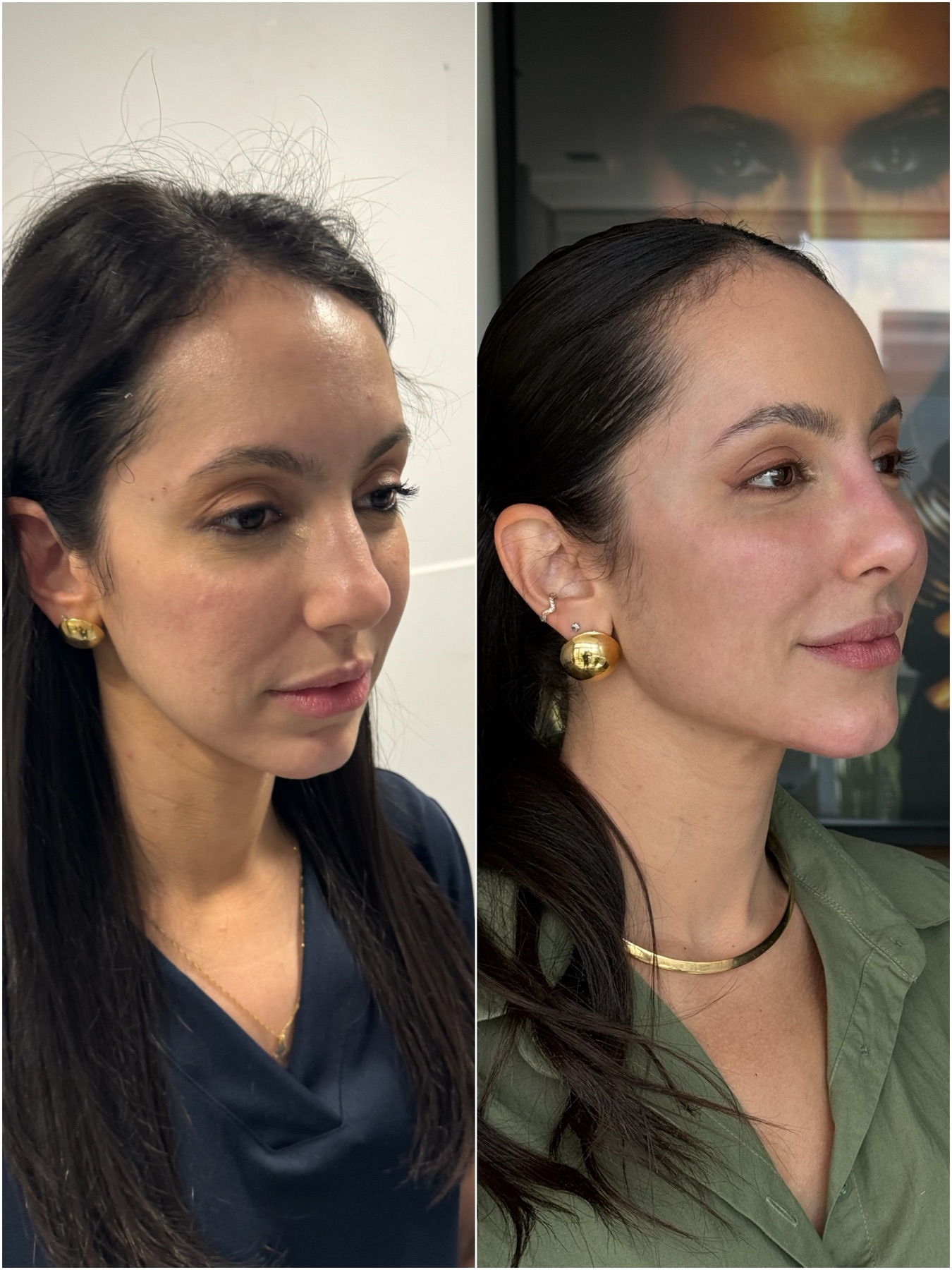 Harmonização facial — resultado de harmonização facial na RUV