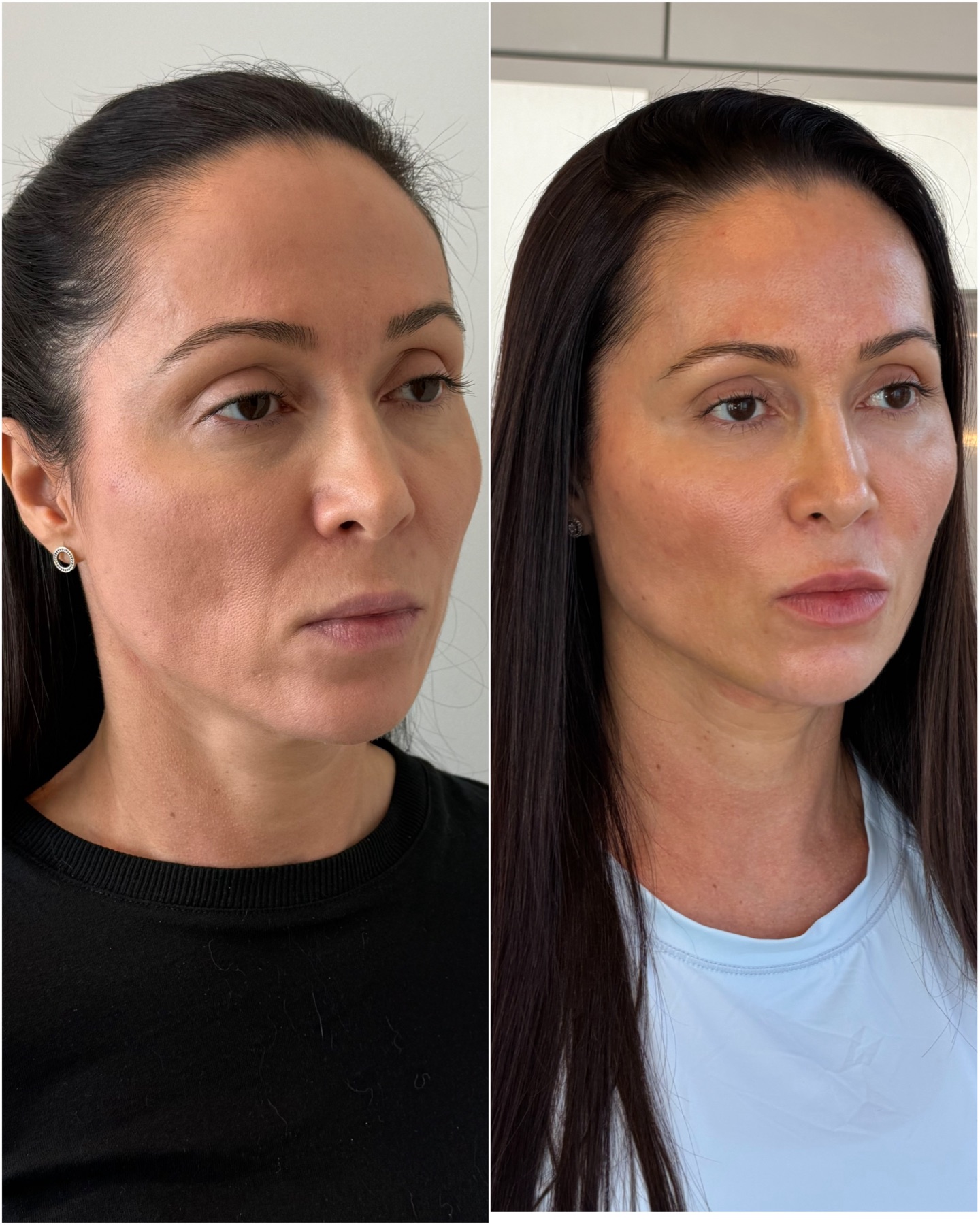 Harmonização facial — resultado de harmonização facial na RUV