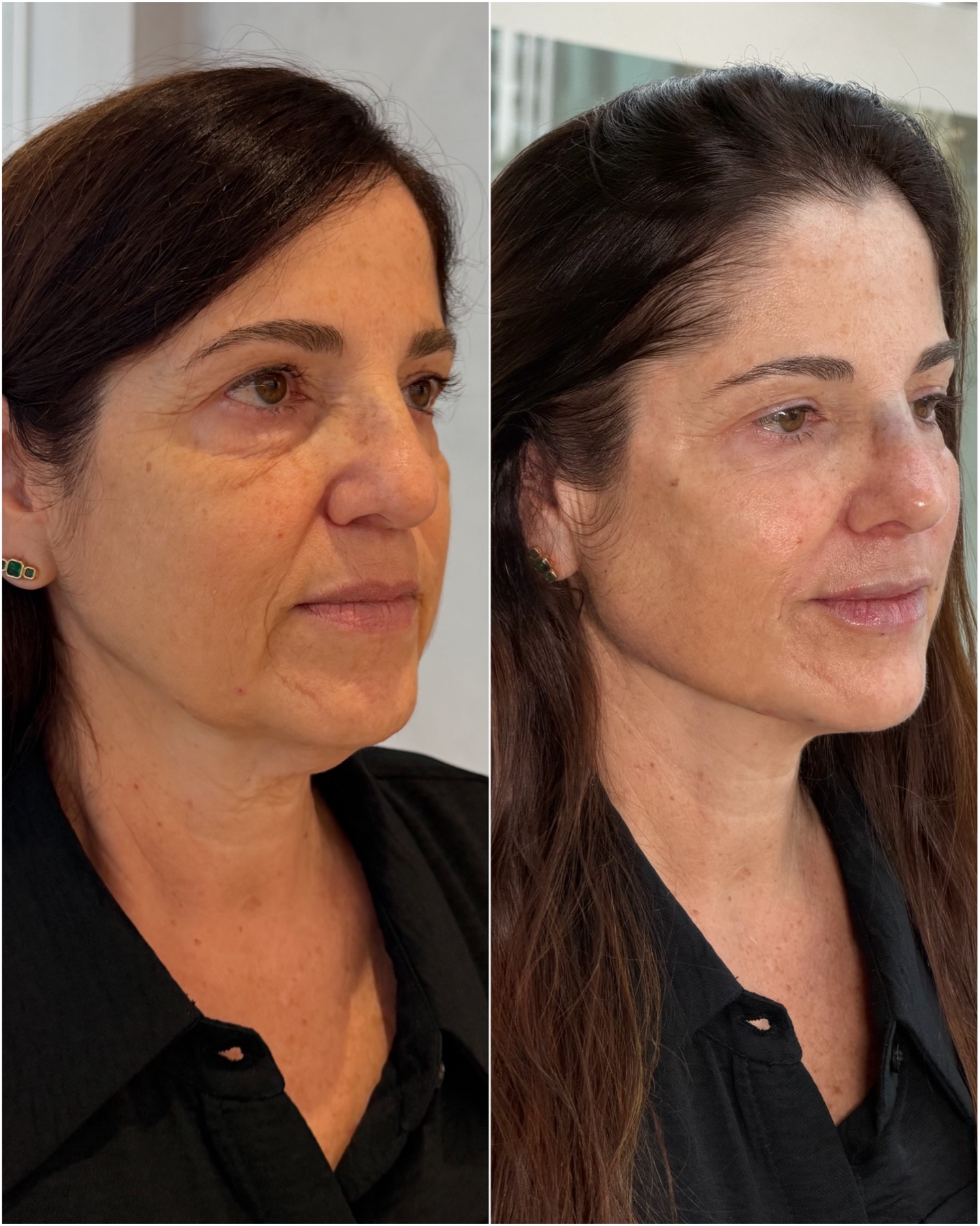 Harmonização facial — resultado de harmonização facial na RUV