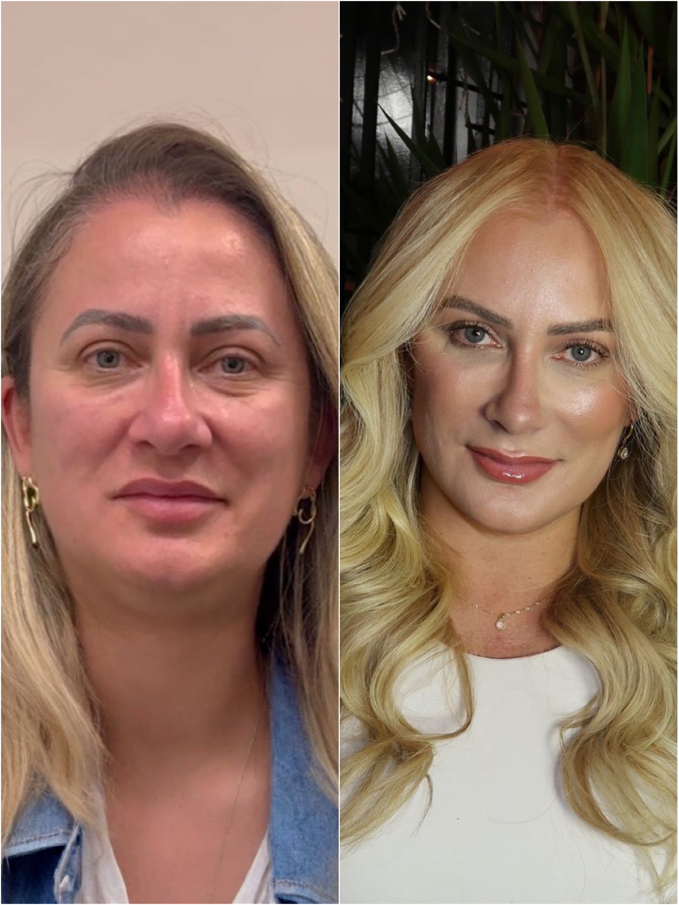 Harmonização facial — resultado de harmonização facial na RUV